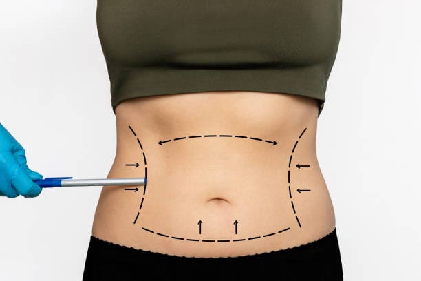 What-Makes-Liposuction-A-Top-Choice-For-Targeted-Fat-Loss