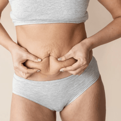 What-Mini-Abdominoplasty-Does-for-Your-Tummy