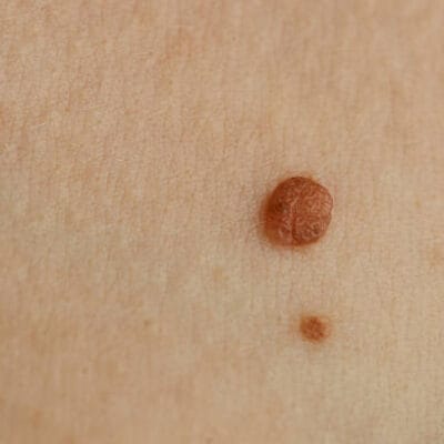 What-Questions-Should-You-Ask-Before-Skin-Tag-Removal