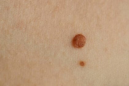 What-Questions-Should-You-Ask-Before-Skin-Tag-Removal