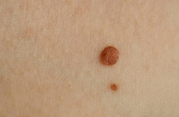 What-Questions-Should-You-Ask-Before-Skin-Tag-Removal