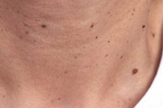 warts