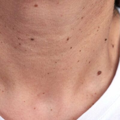 warts