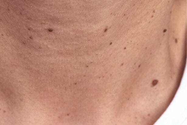 warts
