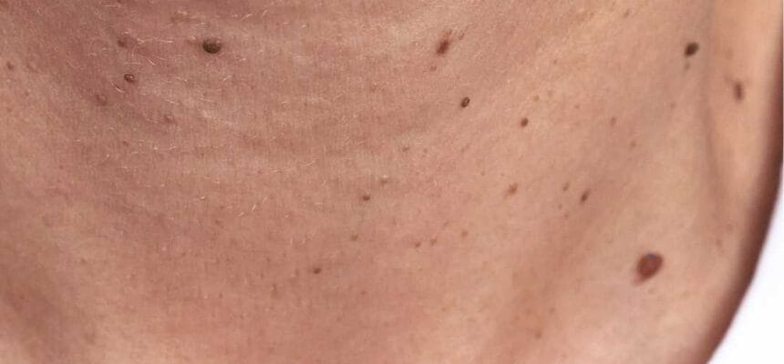 warts